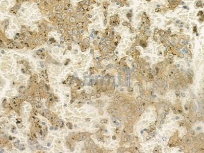 IL7R Antibody - DF6362 at 1/100 staining human melanoma by IHC-P.