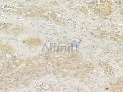 IL7R Antibody - DF6362 at 1/100 staining human lung squamous cell carcinoma by IHC-P.