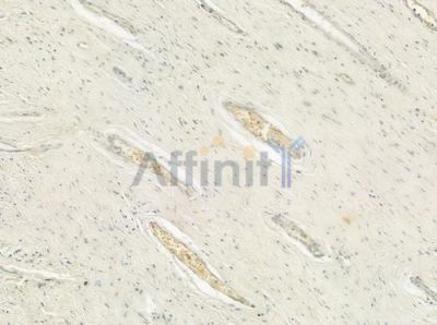 CDC20 Antibody - DF6363 at 1/100 staining human pancreatic carcinoma by IHC-P.