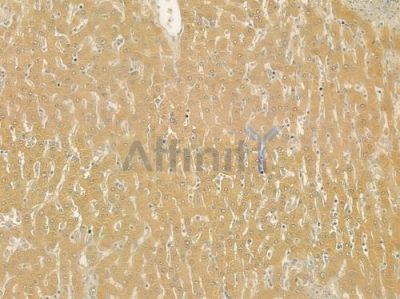 Glycophorin C/GPC Antibody - DF6364 at 1/100 staining human hepatocellular carcinoma by IHC-P.