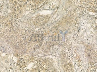 Glycophorin C/GPC Antibody - DF6364 at 1/100 staining human cervical carcinoma by IHC-P.