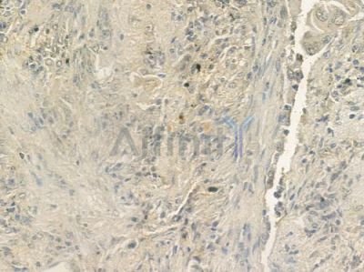 KLRC1 Antibody - DF6365 at 1/100 staining human lung adenocarcinoma by IHC-P.