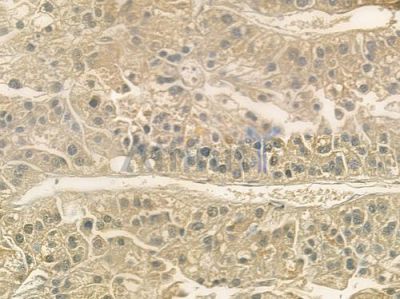 PLA2G2A Antibody - DF6366 at 1/100 staining human hepatocellular carcinoma by IHC-P.