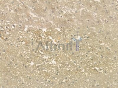 PLA2G2A Antibody - DF6366 at 1/100 staining human glioblastoma by IHC-P.