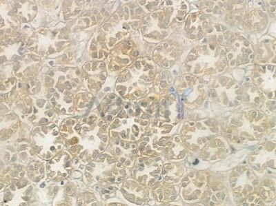 Ataxin 3 Antibody - DF6375 at 1/100 staining human renal cell carcinoma by IHC-P.