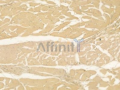 OGG1 Antibody - DF6401 at 1/100 staining human tongue carcinoma by IHC-P.