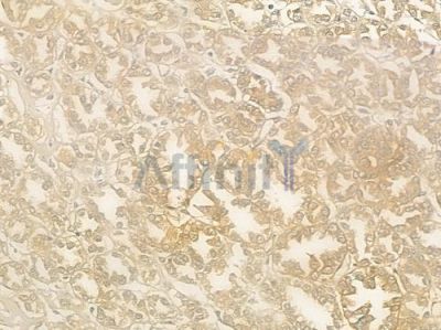 OGG1 Antibody - DF6401 at 1/100 staining human renal cell carcinoma by IHC-P.