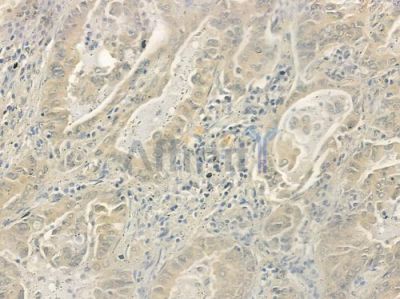 LIPC Antibody - DF6411 at 1/100 staining human lung adenocarcinoma by IHC-P.