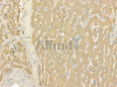 CES2 Antibody - DF6433 at 1/100 staining human hepatocellular carcinoma by IHC-P.