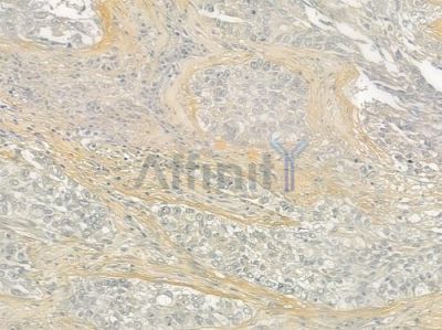 Collagen V  alpha 1 Antibody - DF6434 at 1/100 staining human lung squamous cell carcinoma by IHC-P.