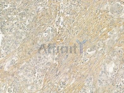 Collagen V  alpha 1 Antibody - DF6434 at 1/100 staining human ovarian carcinoma by IHC-P.