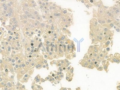 HP Antibody - DF6467 at 1/100 staining human hepatocellular carcinoma by IHC-P.