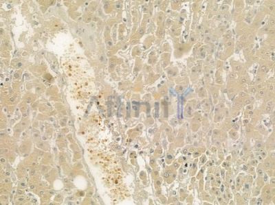 alpha 2 Macroglobulin/A2M Antibody - DF6469 at 1/100 staining human hepatocellular carcinoma by IHC-P.