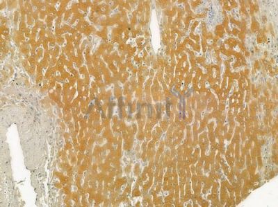 SERPINC1 Antibody - DF6470 at 1/100 staining human hepatocellular carcinoma by IHC-P.