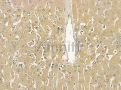 SULT1A1 Antibody - DF6490 at 1/100 staining human hepatocellular carcinoma by IHC-P.
