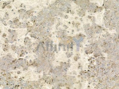 KIR3DL1 Antibody - DF6505 at 1/100 staining human melanoma by IHC-P.