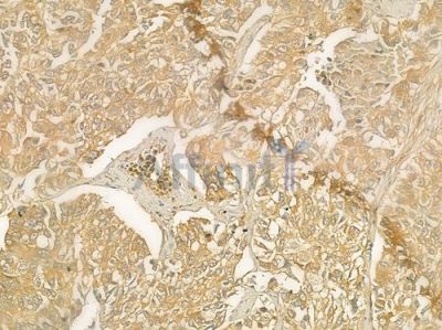 DPYD Antibody - DF6507 at 1/100 staining human lung squamous cell carcinoma by IHC-P.