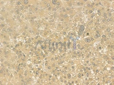 HMGCR Antibody - DF6518 at 1/100 staining human hepatocellular carcinoma by IHC-P.