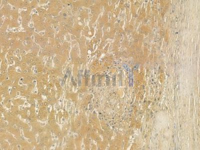 RASA1 Antibody - DF6519 at 1/100 staining human hepatocellular carcinoma by IHC-P.