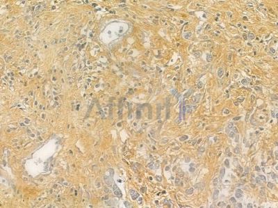 RASA1 Antibody - DF6519 at 1/100 staining human gastric carcinoma by IHC-P.