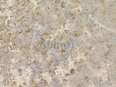 SAA1/2 Antibody - DF6533 at 1/100 staining human melanoma by IHC-P.