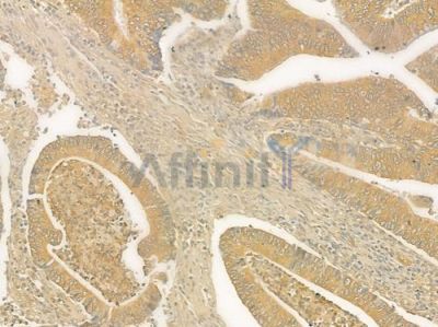 UGT1A9 Antibody - DF6537 at 1/100 staining human colon carcinoma by IHC-P.