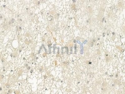 Substance P Antibody - DF6541 at 1/100 staining human astrocytoma by IHC-P.