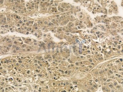 SLC22A5 Antibody - DF6549 at 1/100 staining human hepatocellular carcinoma by IHC-P.