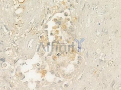 XRCC4 Antibody - DF6550 at 1/100 staining human prostate carcinoma by IHC-P.
