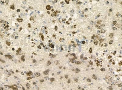CDK7 Antibody - DF6559 at 1/100 staining human melanoma by IHC-P.