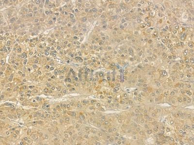 KIR2DL1 Antibody - DF6560 at 1/100 staining human hepatocellular carcinoma by IHC-P.