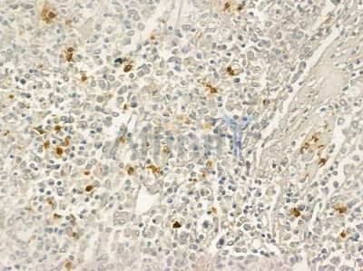 CD66/CEACAM1 Antibody - DF6564 at 1/100 staining human Hodgkin lymphoma by IHC-P.