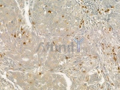 CD66/CEACAM1 Antibody - DF6564 at 1/100 staining human lung squamous cell carcinoma by IHC-P.