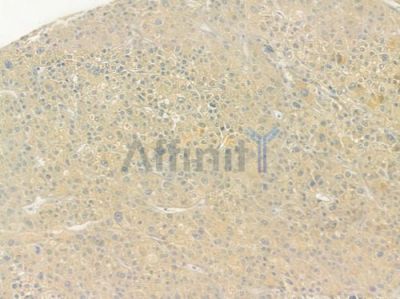 SERPING1 Antibody - DF6572 at 1/100 staining human hepatocellular carcinoma by IHC-P.