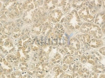 TRAP220/MED1 Antibody - DF6578 at 1/100 staining human renal cell carcinoma by IHC-P.