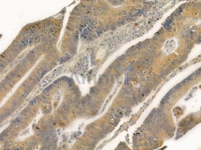 FXN Antibody - DF6590 at 1/100 staining human colon carcinoma by IHC-P.