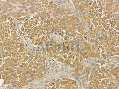 IFNAR2 Antibody - DF6605 at 1/100 staining human lung squamous cell carcinoma by IHC-P.