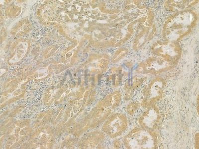 CTSK Antibody - DF6614 at 1/100 staining human lung adenocarcinoma by IHC-P.