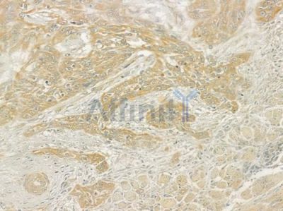 CTSK Antibody - DF6614 at 1/100 staining human tongue carcinoma by IHC-P.