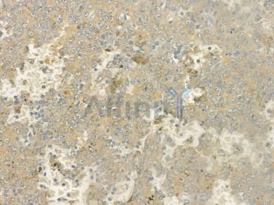 PSAP Antibody - DF6636 at 1/100 staining human melanoma by IHC-P.