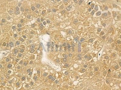 IL2RG Antibody - DF6642 at 1/100 staining human hepatocellular carcinoma by IHC-P.