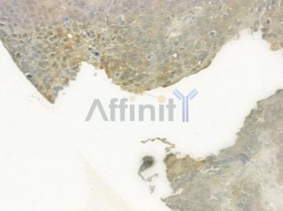 RPB11 Antibody - DF6653 at 1/100 staining human ovarian carcinoma by IHC-P.