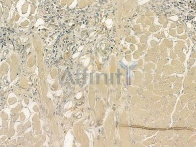 RPGR Antibody - DF6654 at 1/100 staining human tongue carcinoma by IHC-P.