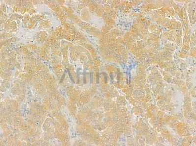 GLB1 Antibody - DF6667 at 1/100 staining human lung adenocarcinoma by IHC-P.