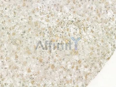 RUVBL2 Antibody - DF6684 at 1/100 staining human astrocytoma by IHC-P.