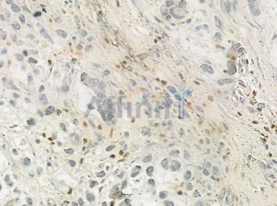 MNAT1 Antibody - DF6690 at 1/100 staining human gastric carcinoma by IHC-P.