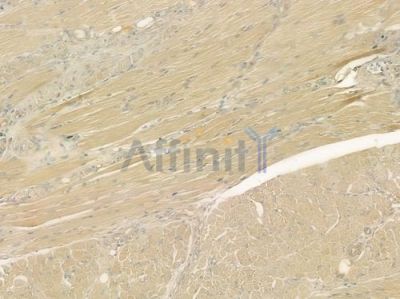 UMOD Antibody - DF6692 at 1/100 staining human tongue carcinoma by IHC-P.