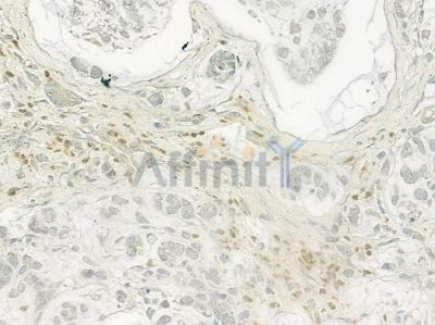 BUB1 Antibody - DF6698 at 1/100 staining human gastric carcinoma by IHC-P.