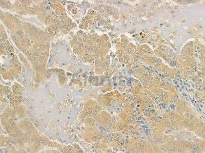 MSMB Antibody - DF6720 at 1/100 staining human lung adenocarcinoma by IHC-P.