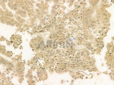 NDP Antibody - DF6721 at 1/100 staining human hepatocellular carcinoma by IHC-P.